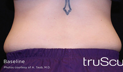 truSculpt 3D