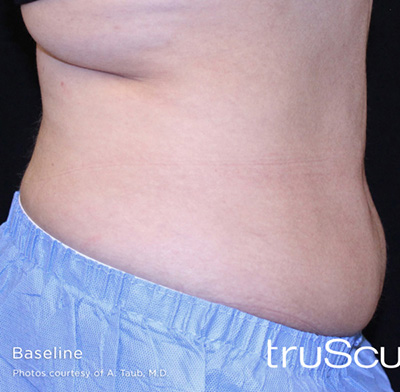 truSculpt 3D