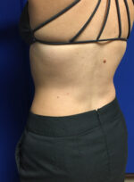 CoolSculpting