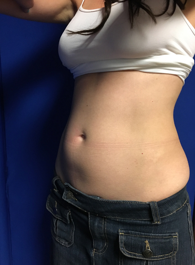 CoolSculpting