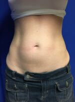 CoolSculpting