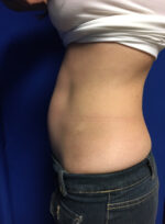 CoolSculpting