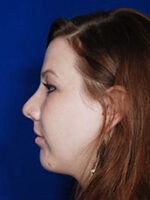 Chin Implant