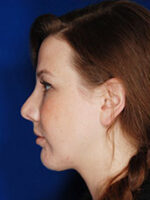 Chin Implant