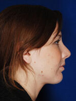 Chin Implant