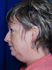 Chin Implant