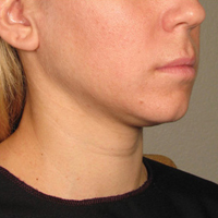 Non-Surgical Skin Tightening