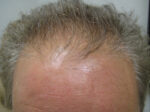 Hair Transplant