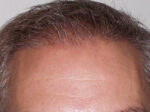 Hair Transplant