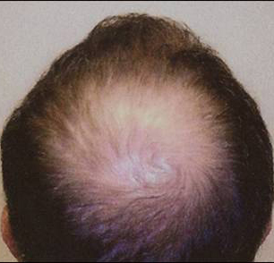 Hair Transplant