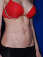 Abdominoplasty