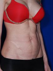 Abdominoplasty