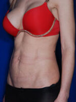 Abdominoplasty