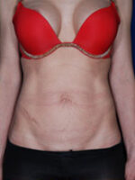 Abdominoplasty