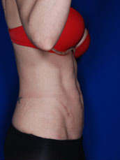 Abdominoplasty