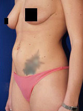 Abdominoplasty