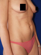 Abdominoplasty