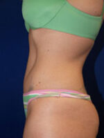 Abdominoplasty