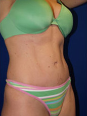 Abdominoplasty