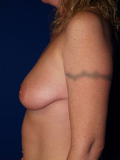 Breast Augmentation & Lift