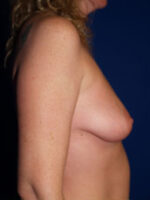 Breast Augmentation & Lift