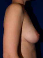 Breast Augmentation & Lift