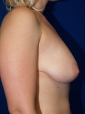 Breast Augmentation & Lift