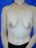 Breast Augmentation & Lift