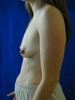 Breast Augmentation & Lift