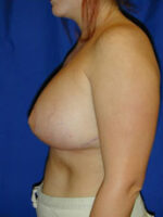 Breast Augmentation & Lift