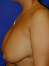 Breast Augmentation & Lift