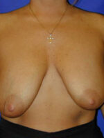 Breast Augmentation & Lift