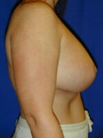 Breast Augmentation & Lift