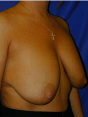 Breast Augmentation & Lift