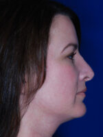 Rhinoplasty