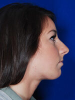 Chin Implant