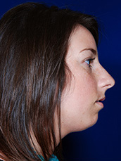 Chin Implant