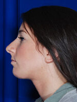 Chin Implant