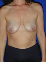 Breast Augmentation & Lift