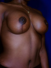 Breast Augmentation & Lift