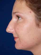 Rhinoplasty