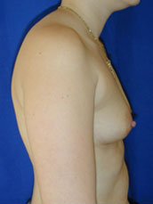 Breast Augmentation