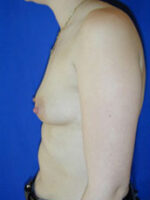 Breast Augmentation