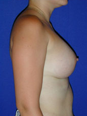 Breast Augmentation