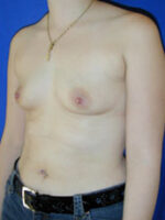 Breast Augmentation