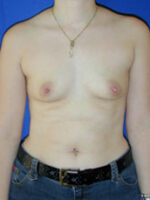 Breast Augmentation