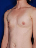 Breast Augmentation