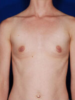 Breast Augmentation