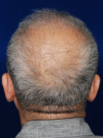 Hair Transplant