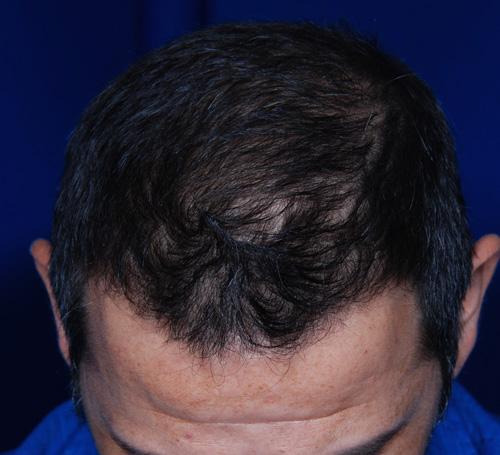 Hair Transplant